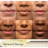 Bálsamo labial para tratamento de terapia avançada SugarSugar Advanced Therapy Treatment protetor labial