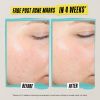 Hidratante habilmente transparente para peles com tendência a acne com ácido salicílico